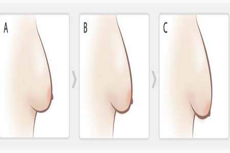 如何預(yù)防胸部松弛？吃什么能使胸部挺拔？