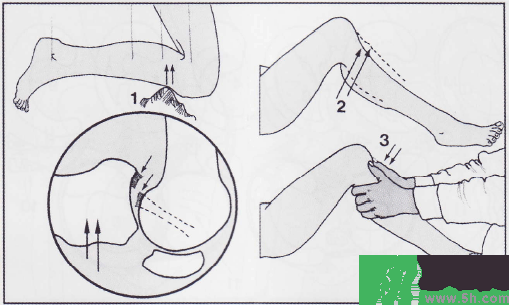 韌帶斷裂吃什么好得快？前十字韌帶斷裂吃什么補品？