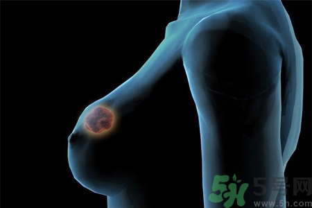 乳房有硬塊正常嗎？乳房有腫塊怎么回事？