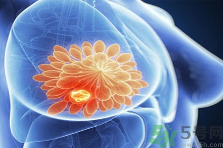 乳房屋硬塊有疼痛感怎么回事？乳房屋硬塊有疼痛感怎么辦？