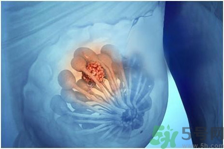 怎樣區(qū)分乳房包塊是良性還是惡性？如何診斷乳房腫塊是惡性還是良性？