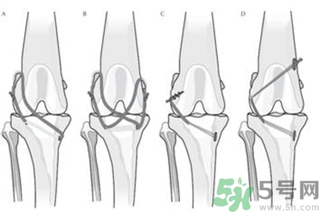 前十字韌帶斷裂可以參加比賽嗎？前十字韌帶斷裂怎么治療？