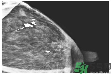 產(chǎn)生乳腺增生鈣化的病因是什么？乳腺增生怎樣治療？
