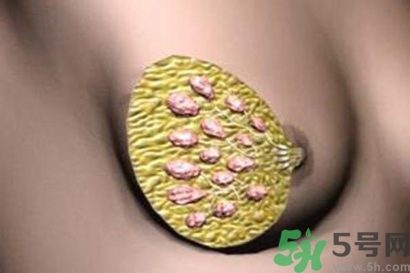 乳腺增生鈣化是什么？乳腺鈣化的癥狀有哪些？