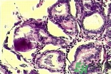 乳腺增生鈣化是什么？乳腺鈣化的癥狀有哪些？