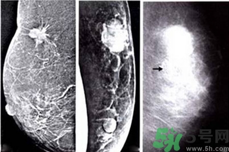 乳腺增生鈣化是什么？乳腺鈣化的癥狀有哪些？