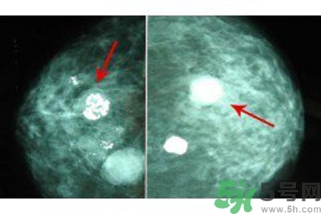 乳腺增生鈣化是什么？乳腺鈣化的癥狀有哪些？