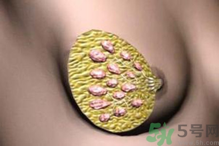 產(chǎn)生乳腺增生鈣化的病因是什么？乳腺增生怎樣治療？