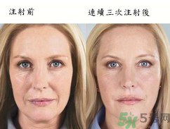 3D液態(tài)拉皮多少錢(qián)？3D液態(tài)拉皮后多久見(jiàn)效？