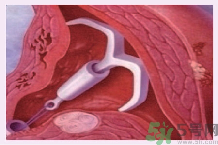 什么是宮內(nèi)節(jié)育器？放置宮內(nèi)節(jié)育器為什么能避孕？