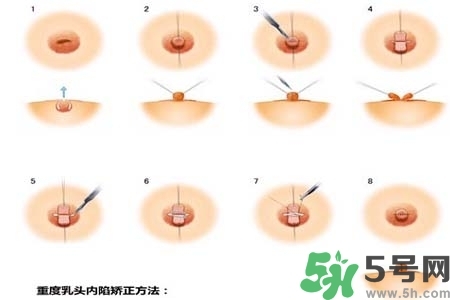 乳頭內(nèi)陷怎么矯正？乳頭內(nèi)陷矯正方法是什么？
