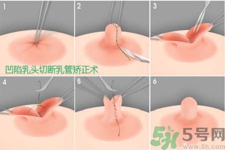 乳頭內(nèi)陷怎么矯正？乳頭內(nèi)陷矯正方法是什么？