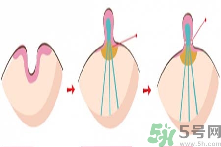 乳頭內(nèi)陷矯正需注意什么？乳頭內(nèi)陷如何預(yù)防？