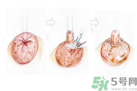 乳頭內(nèi)陷矯正需注意什么？乳頭內(nèi)陷如何預(yù)防？