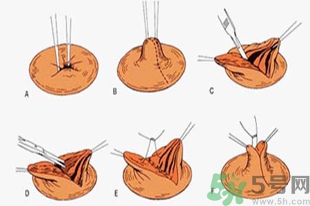乳頭內(nèi)陷能不能喂奶？乳頭凹陷怎樣哺乳？