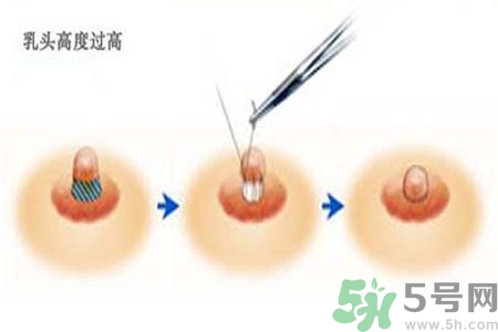乳頭內(nèi)陷能不能喂奶？乳頭凹陷怎樣哺乳？