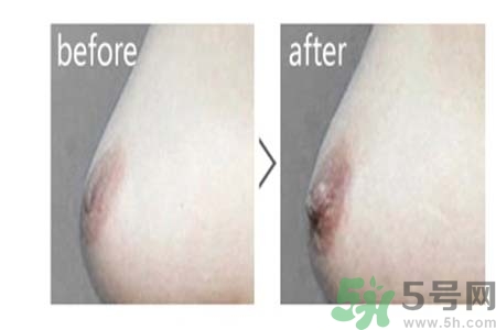 乳頭內(nèi)陷能不能喂奶？乳頭凹陷怎樣哺乳？