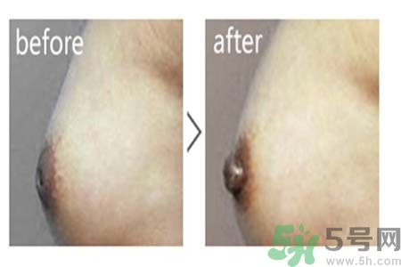 乳頭內(nèi)陷可以用吸奶器嗎？乳頭內(nèi)陷能不能用吸奶器？