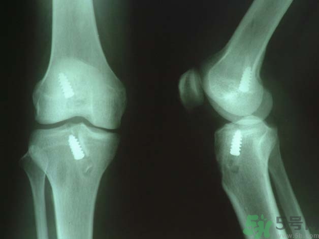 韌帶斷裂吃什么好得快？前十字韌帶斷裂吃什么補品？