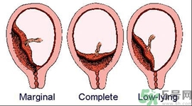 陰道出血是怎么回事？如何預(yù)防陰道出血？