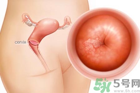 陰道松弛是什么？陰道松弛的癥狀有哪些？