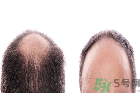 頭發(fā)稀少的原因是什么？如何預(yù)防禿頂?shù)陌l(fā)生？