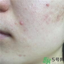 寶拉珍選水楊酸有用嗎?寶拉水楊酸怎么樣? 寶拉珍選水楊酸有用嗎?寶拉水楊酸怎么樣?