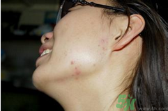 腮幫子長(zhǎng)痘痘是什么原因？腮幫子長(zhǎng)痘痘怎么調(diào)理？