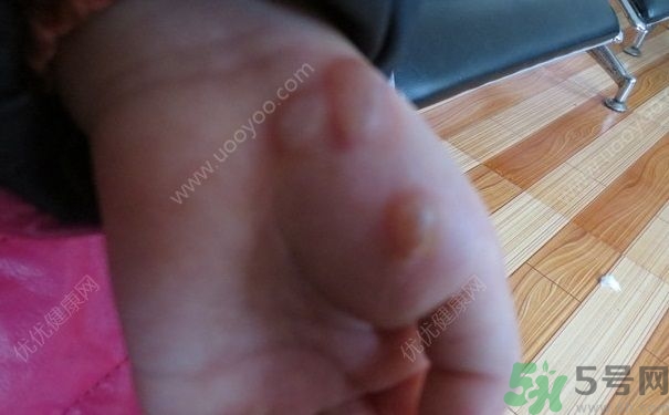 15歲還會得手足口病嗎？手足口病的癥狀有哪些？