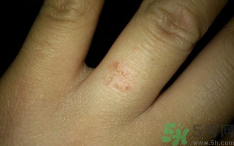 手上長水泡是什么原因?手上長水泡很癢怎么辦? 手上長水泡是什么原因?手上長水泡很癢怎么辦?