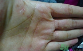 手上長水泡是什么原因?手上長水泡很癢怎么辦? 手上長水泡是什么原因?手上長水泡很癢怎么辦?