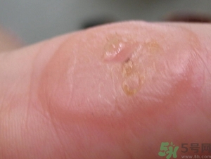 手上長水泡是什么原因?手上長水泡很癢怎么辦? 手上長水泡是什么原因?手上長水泡很癢怎么辦?
