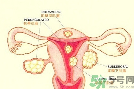 ?子宮移位怎么治療？子宮移位能懷孕嗎？