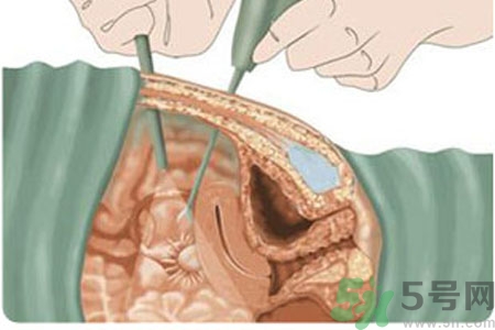 子宮移位的原因是什么？子宮移位的癥狀有哪些？