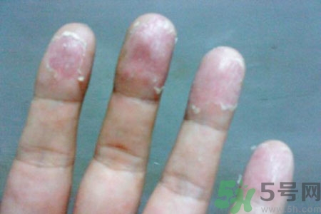 ?手掌脫皮的危害有哪些？如何預(yù)防手掌脫皮？