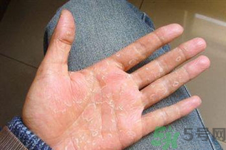 ?手掌脫皮的危害有哪些？如何預(yù)防手掌脫皮？