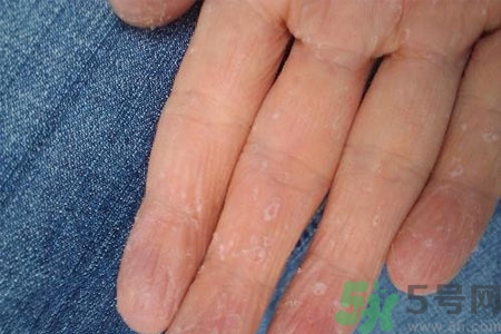 ?手掌脫皮的危害有哪些？如何預(yù)防手掌脫皮？