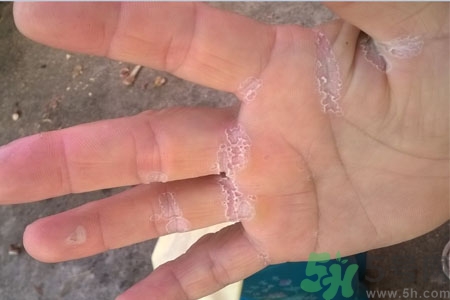 ?手掌脫皮的危害有哪些？如何預(yù)防手掌脫皮？