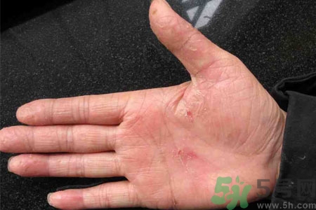 手脫皮是什么原因？手脫皮的治療方法是什么？