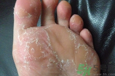 腳脫皮的治療方法有哪些？如何預(yù)防腳脫皮？
