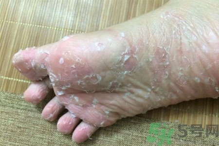 腳脫皮的治療方法有哪些？如何預(yù)防腳脫皮？
