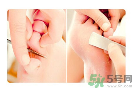 雞眼如何去除？腳上長(zhǎng)了雞眼怎么治療？