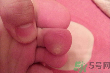 雞眼如何去除？腳上長(zhǎng)了雞眼怎么治療？