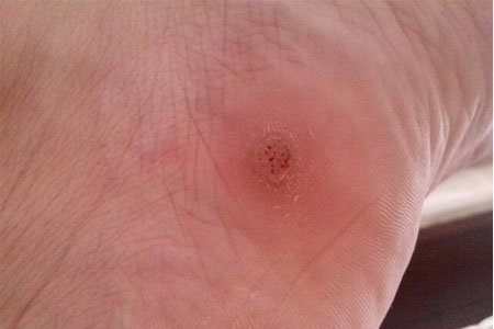 雞眼如何去除？腳上長了雞眼怎么治療？