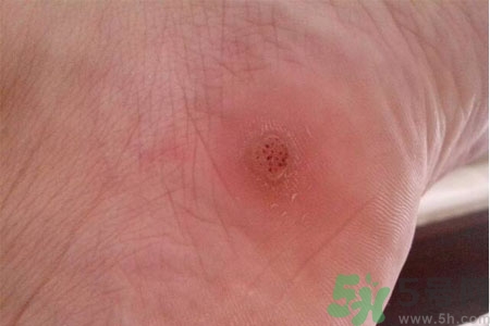 腳上長雞眼是怎么回事？腳上長雞眼是怎么辦？