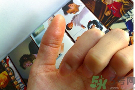 腳上長雞眼是怎么回事？腳上長雞眼是怎么辦？