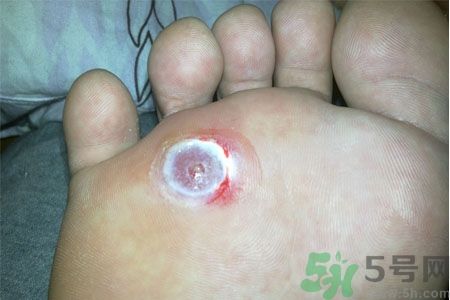 腳上長雞眼是怎么回事？腳上長雞眼是怎么辦？