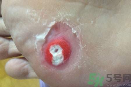 雞眼怎么能徹底根治？如何預(yù)防腳上長雞眼？