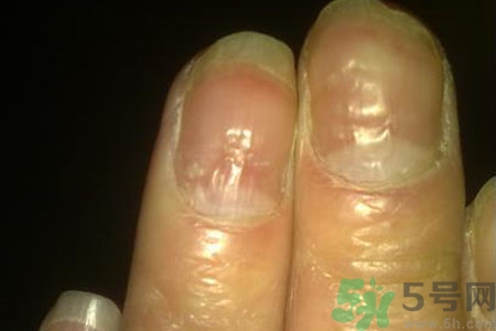 孩子手指甲凹凸不平是什么原因？手指甲凹凸不平的原因是什么？