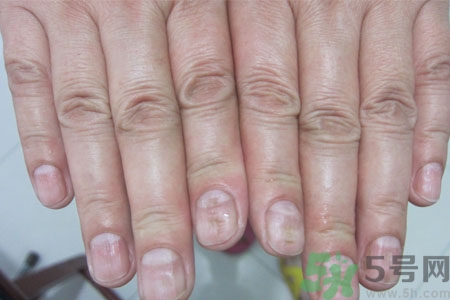 孩子手指甲凹凸不平是什么原因？手指甲凹凸不平的原因是什么？